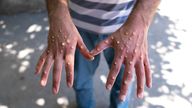 Man with blisters on his hands from monkeypox. File pic: iStock