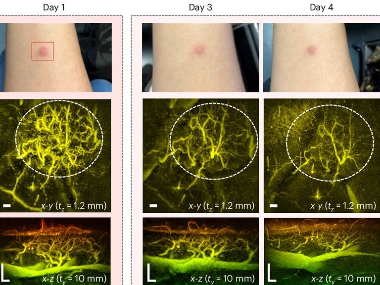 Scans show the inflammation around lump on the skin over a series of days. Pic: University College London