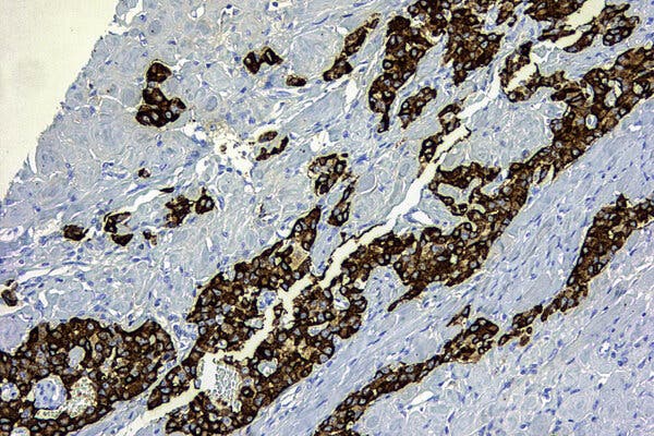 A light micrograph in blue and brown of pancreatic polypeptide cells in a sample of pancreatic cancer tissue.