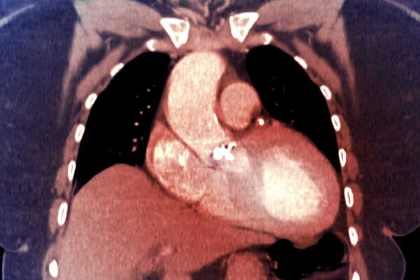 A CT scan in red and purple shows the heart and associated valves and a few other organs in the chest cavity of a patient.