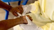 Christian Musema, a laboratory nurse, takes a sample from a child declared a suspected case of Mpox - an infectious disease caused by the monkeypox virus that sparks off a painful rash, enlarged lymph nodes and fever; at the treatment centre in Munigi, following Mpox cases in Nyiragongo territory near Goma, North Kivu province, Democratic Republic of the Congo July 19, 2024. REUTERS/Arlette Bashizi