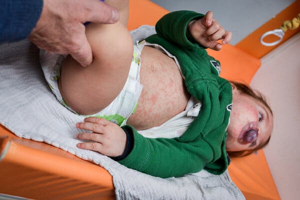 A baby with a pacifier on its back covered in measles rashes being examined by a doctor, whose hand holds the baby's left leg.