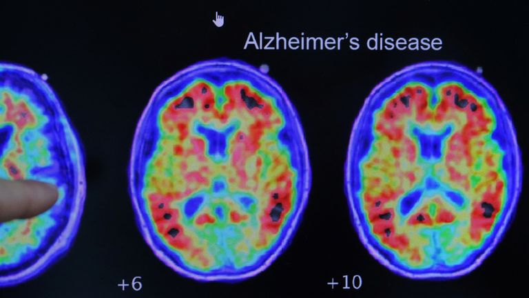 A brain scan of someone with Alzheimer's disease.
Pic: Reuters