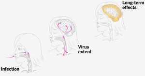 2025-03-20-measles-emma-index-facebookjumbo-v5